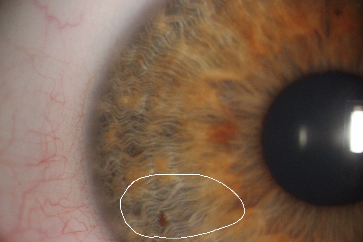 Zdjęcie tęczówki oka wykonane podczas badania. Widać z bliska tęczówkę. Jest zaznaczone kółeczko w celu pokazania opisanych w tekście zmian